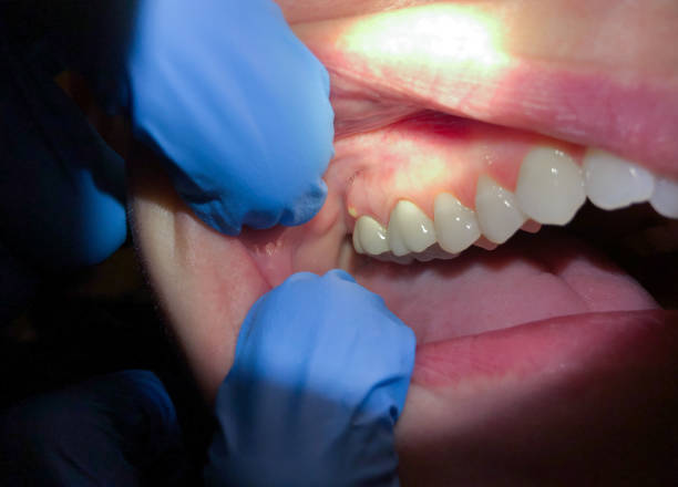 Best Emergency Root Canal Treatment in Montebello, NY