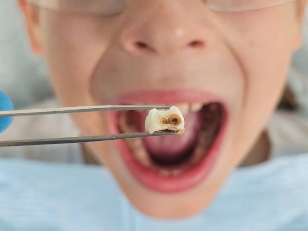 Best Emergency Wisdom Teeth Removal in Montebello, NY